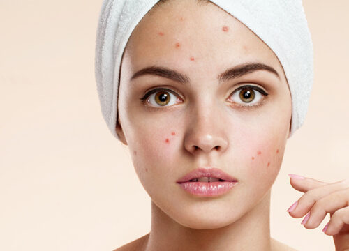 Photo of a woman with acne and acne scarring