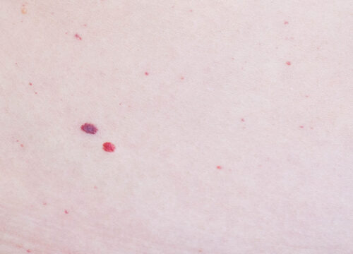 Photo of a hemangioma on a person's skin
