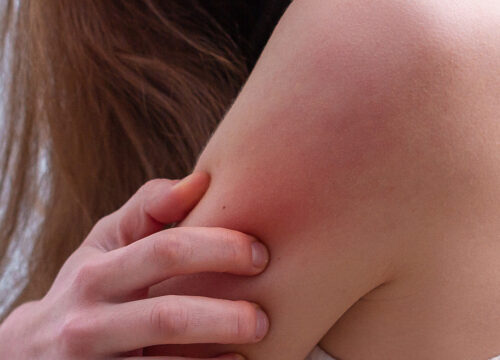 Photo of a woman with a psoriasis rash on her arm