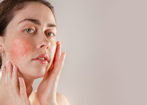 Photo of a woman with rosacea on her cheek